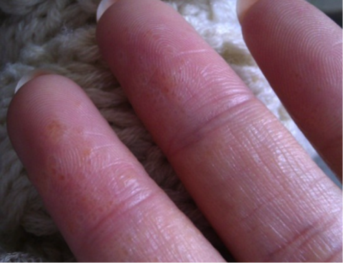 中西醫(yī)鵝掌風(fēng)怎樣治療，預(yù)防手癬的方法